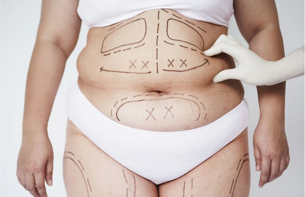 Как убрать лишний жир с живота? Абдоминопластика, липосакция или ЗОЖ? - Пластический хирург Баков В. С.