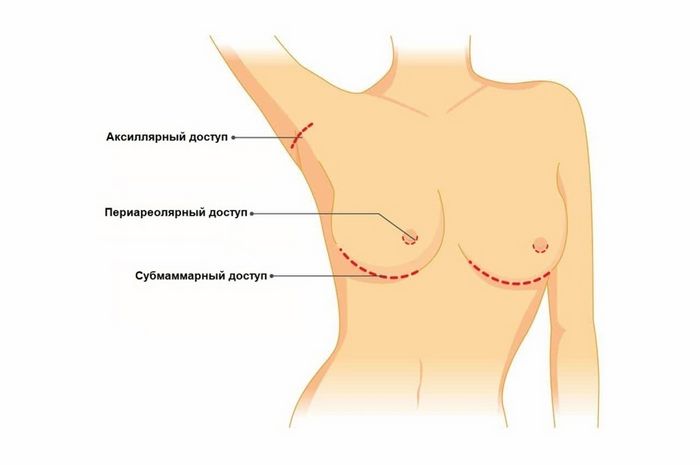 Виды хирургического доступа при увеличении груди