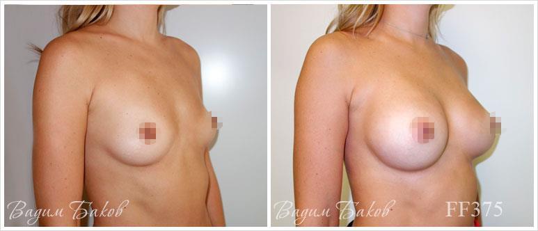 Увеличение груди. Результат после операция по увеличению груди у пациентки доктора Бакова