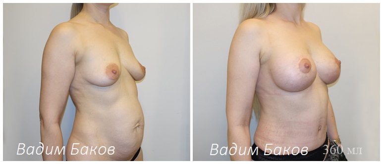 Сочетанные операции (грудь и тело)