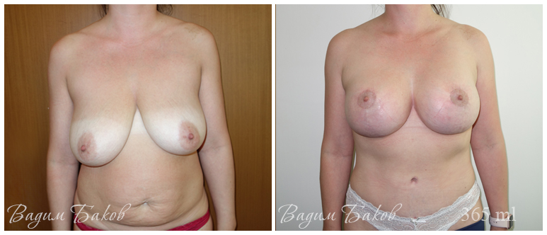 Сочетанные операции (грудь и тело)