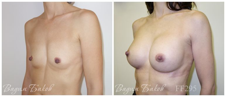 Увеличение груди (анатомические импланты) 280-295 мл