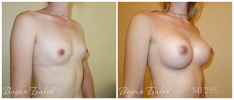 Увеличение груди (анатомические импланты) 280-295 мл