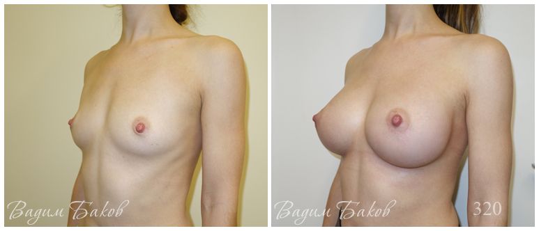 Увеличение груди (анатомические импланты). 310-335 мл