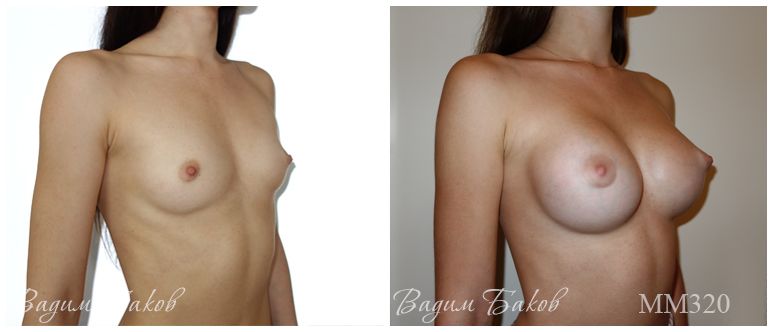 Увеличение груди (анатомические импланты). 310-335 мл