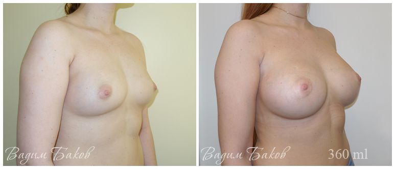 Увеличение груди (анатомические импланты). 350-395 мл