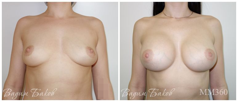 Увеличение груди (анатомические импланты). 350-395 мл