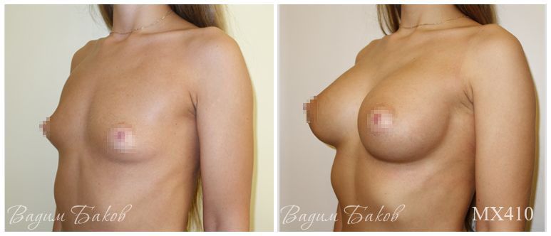 Увеличение груди (анатомические импланты). Более 400 мл