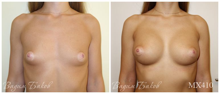 Увеличение груди (анатомические импланты). Более 400 мл