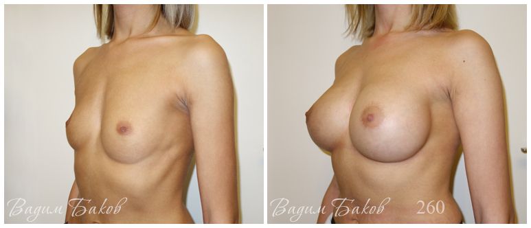 Увеличение груди (анатомические импланты)