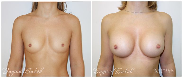 Увеличение груди (анатомические импланты)