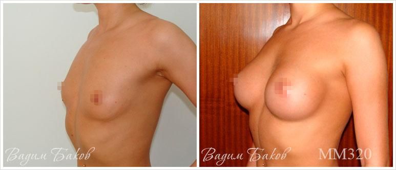 Увеличение груди (круглые импланты)