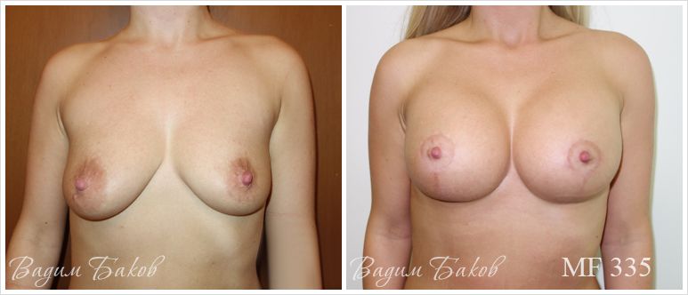 Увеличение груди с Т-образной подтяжкой