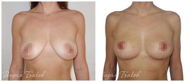 Вертикальная подтяжка груди - фото до и после