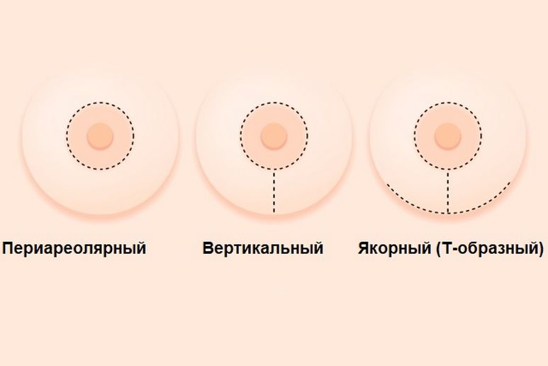 Виды разрезов при мастопексии